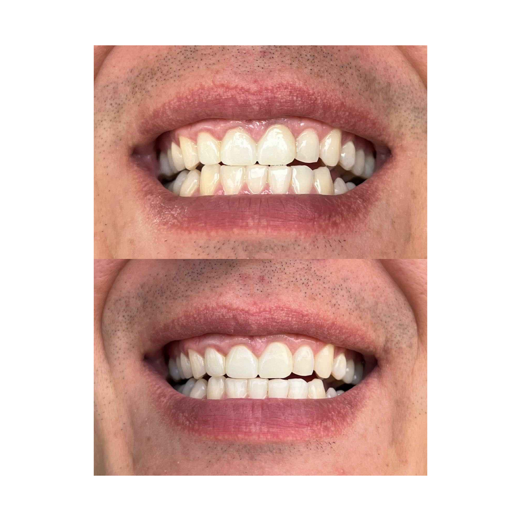 Smile Whitening Bundle