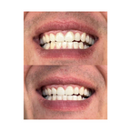 Smile Whitening Bundle